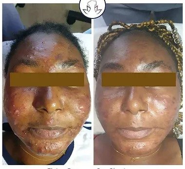 Elaine Brennan Skin Renewal Peeling System